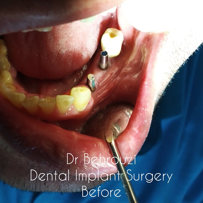 Dental Implant/ایمپلنت دندانی